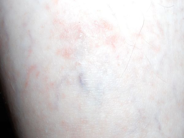 Disgusting leg rash